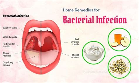 How do I get rid of a bacterial infection in my mouth?