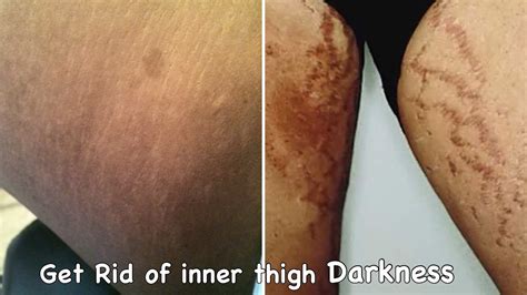 How do I get rid of a dark rash between my thighs?
