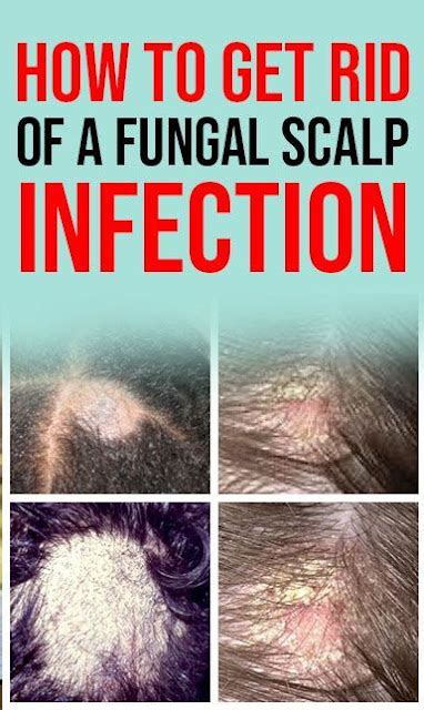 How do I get rid of a fungal infection on my scalp naturally?