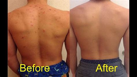 How do I get rid of back and chest acne?