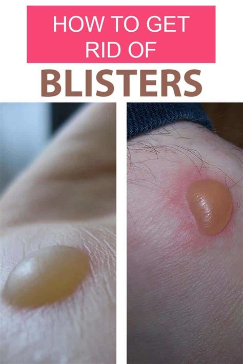 How do I get rid of blisters fast?