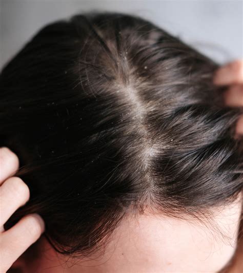 How do I get rid of buildup on my scalp?