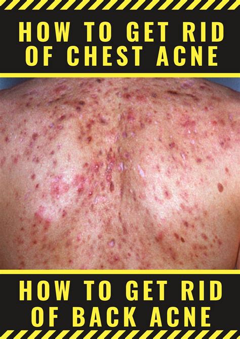How do I get rid of chest and back acne ASAP?