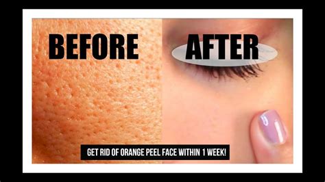 How do I get rid of orange peel texture on my face?