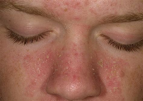 How do I get rid of seborrheic dermatitis on my face forever?