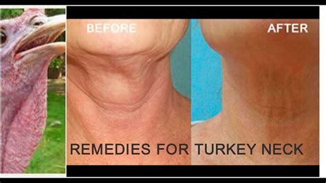 How do I get rid of turkey neck without surgery?