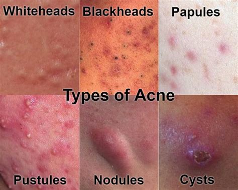 How do I know acne is healing?