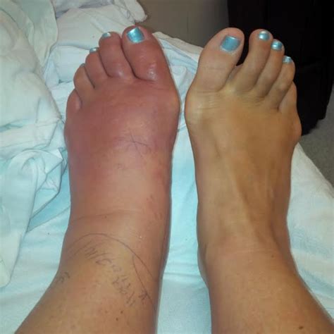 How do I know if I got an infection from a pedicure?