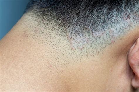 How do I know if I have fungus on my scalp?