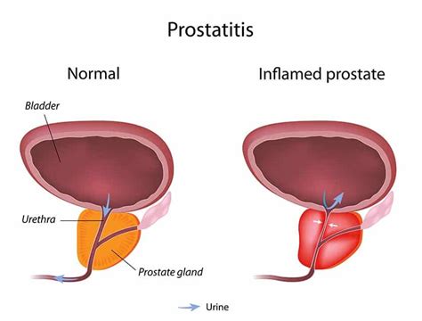 How do I know if I hurt my prostate?