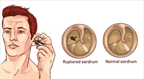 How do I know if I touched my eardrum?