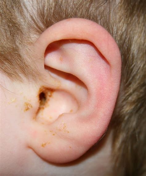 How do I know if my ear infection is severe?