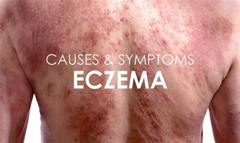 How do I know if my eczema is getting better?