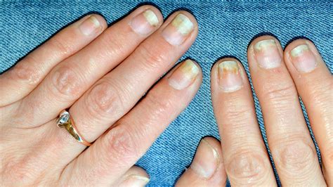 How do I know if my nail is permanently damaged?