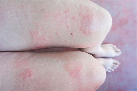 How do I know if my rash is a stress rash?