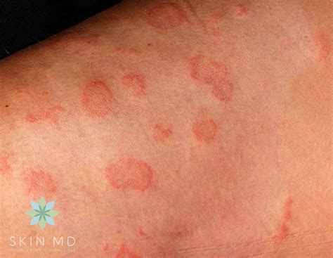 How do I know if my rash is fungal or bacterial?
