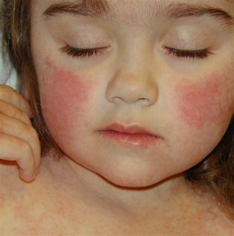 How do I know if my rash is viral?