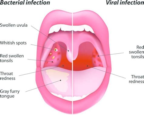 How do I know if my sore throat is viral or bacterial?