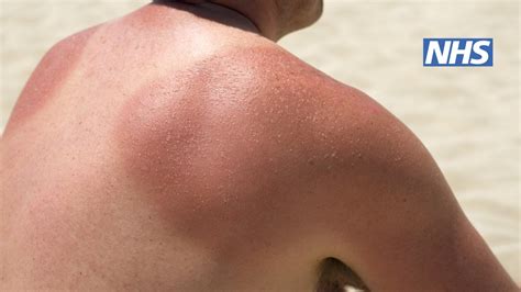 How do I know if my sunburn is mild or severe?