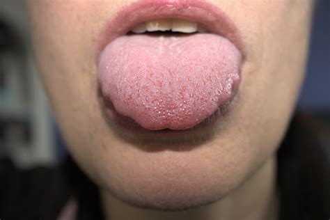 How do I know if my tongue is enlarged?