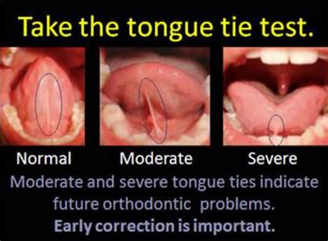 How do I know if my tongue-tie is bad?