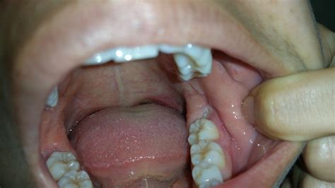 How do I know if my wisdom teeth are coming in?