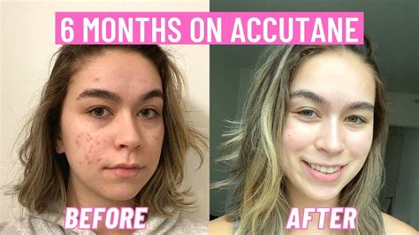 How do I maintain my skin after Accutane?