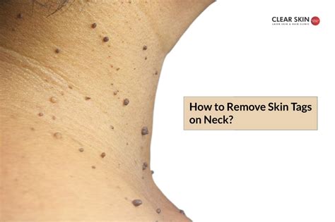 How do I prevent small skin tags on my neck?