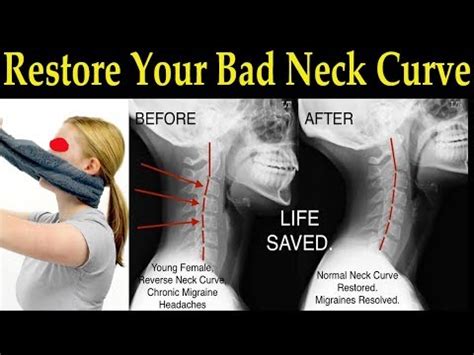 How do I sleep to restore my neck curve?