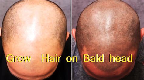 How do I stop my bald head from growing back?