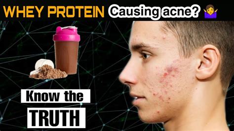 How do bodybuilders avoid acne?