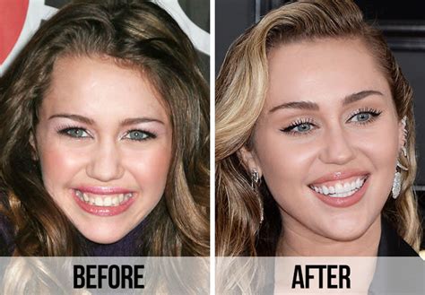 How do celebrities get straight teeth so fast?