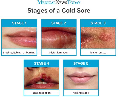 How do cold sores start?