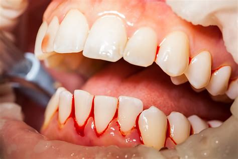 How do dentists treat bleeding gums?