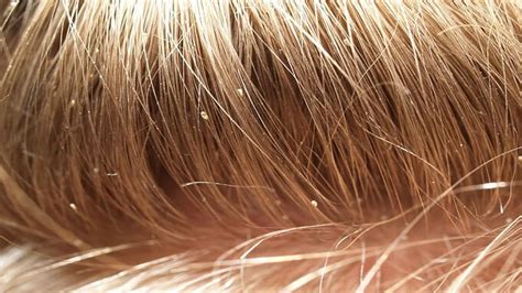 How do head lice look like?