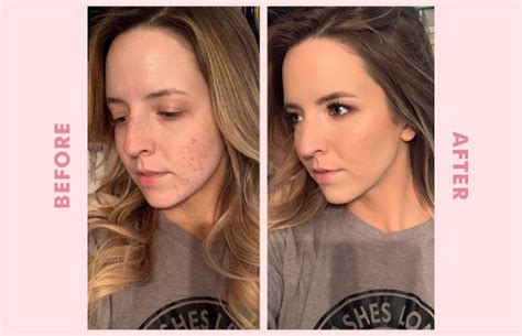 How do makeup artists cover pimples?