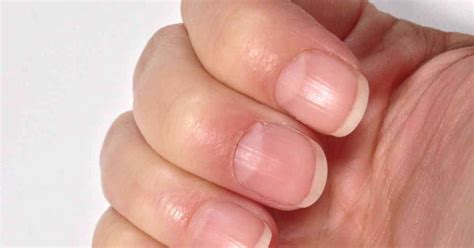 How do nails show anemia?