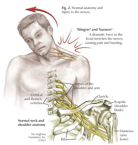 How do you Unpinch C6 nerve?