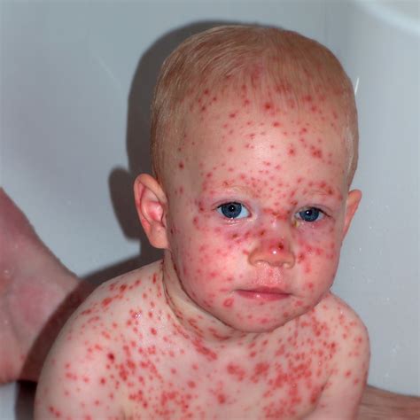 How do you become immune to chickenpox?