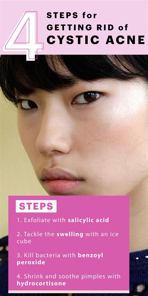 How do you calm cystic acne fast?