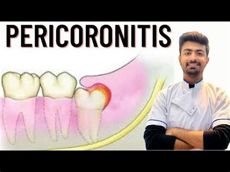 How do you clean pericoronitis?