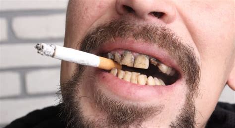 How do you clean your teeth from smoking?