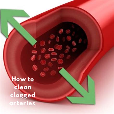 How do you clear a 100% blocked artery?