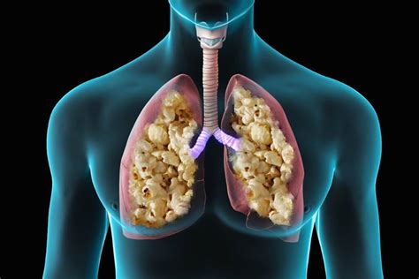 How do you clear popcorn lungs?