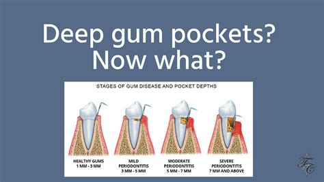 How do you close deep gum pockets?