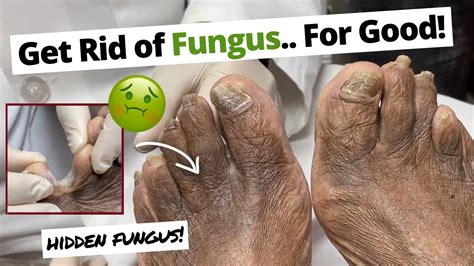 How do you completely kill fungus?