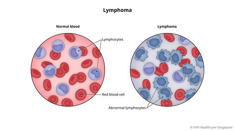 How do you confirm lymphoma?