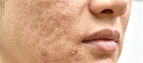 How do you cover up acne holes?