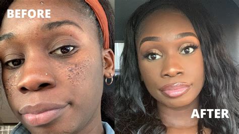 How do you cover up pitted acne scars with makeup?