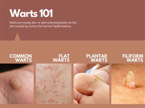 How do you date with warts?